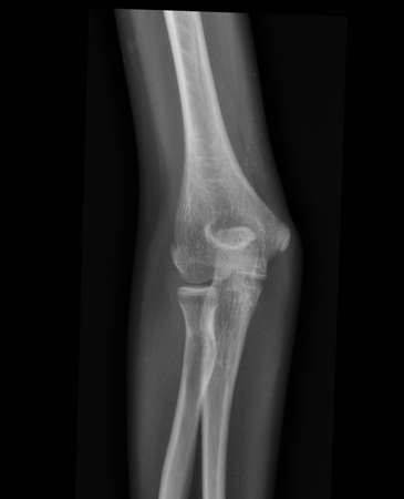 X-ray  human arms broken armの写真素材