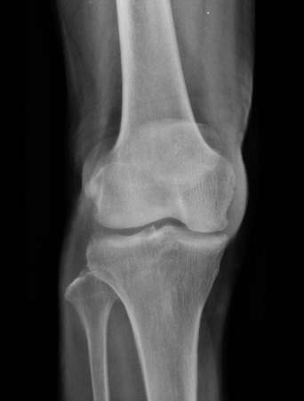 film x-ray knee of osteoarthritis knee patientの写真素材