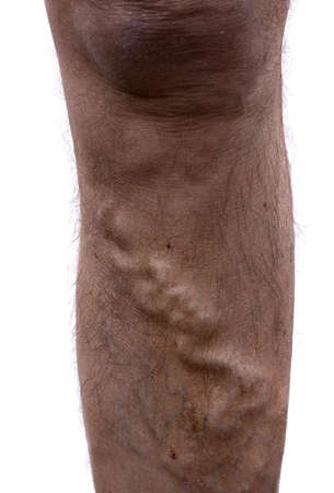 Varicose vein on mans leg.の写真素材