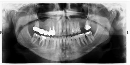 Panoramic X-Ray Image of Teeth の写真素材