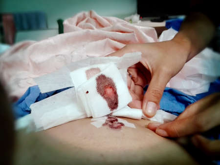 Close up of hands healing wound from surgery on female stomachの写真素材