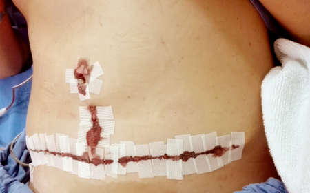 Close up of wound from surgery on female stomachの写真素材