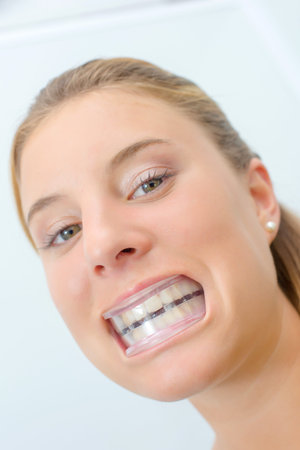 Woman wearing mouth guard after whitening