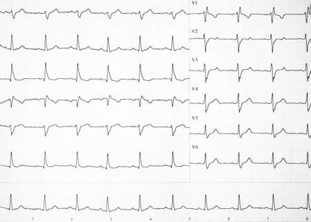 Alterations of heartbeats represented on paper. Heart rate on paper for recording an...