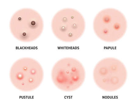 Skin acne types diagram. Vector skin disease pimples blackheads and comedones, cosmetology and skincare problems treatmentのイラスト素材