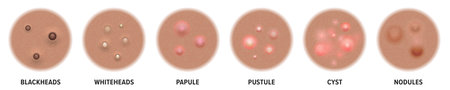 Skin acne type, face pimple and comedone blackhead in pores. Skin acne types skincare cosmetology and treatment.のイラスト素材
