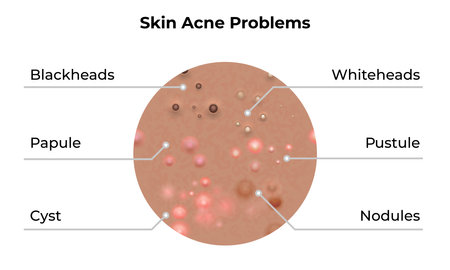 Skin acne types and face pimples for dark skin type, vector, skin care problems treatment. Skin acne dermatology and skincare beauty.のイラスト素材