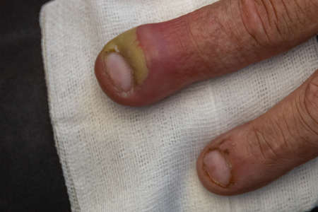 swollen finger of one hand due to dermatologic infection from a pus-filled fingernail and infectious bacteria health care conceptの写真素材