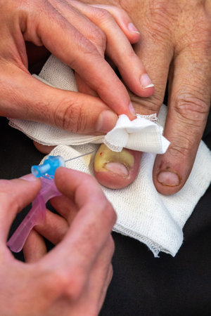 doctor practicing a needle puncture in the finger infected by a fingernail with pus and infectious...