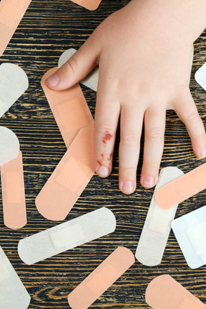 one damaged finger on the hand, a close-up of the hand with the damage that is being treated through...
