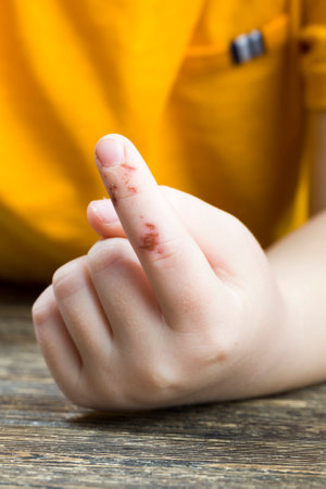 a small injury on the finger of the hand, a close-up of the hand with an injury that is healing or almost healedの写真素材