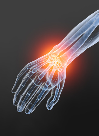 Painful wrist, medically 3D illustration, osteoarthritisの写真素材