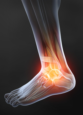 Osteoarthritis, painful ankle joint, 3D illustrationの写真素材