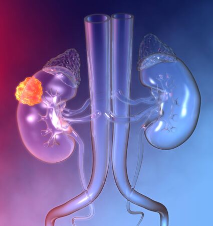 3D Illustration showing a kidney tumor on colorful backgroundの写真素材
