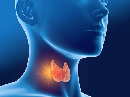Medically 3D illustration showing thyroid cancer of a woman, medically illustration on blue backgroundの写真素材