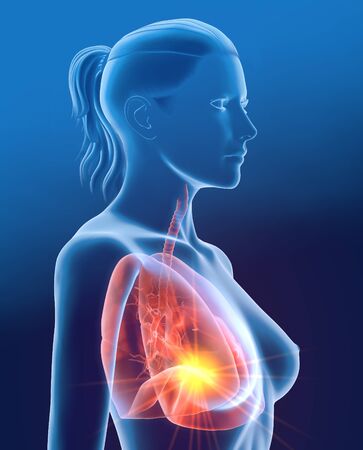 3D illustration showing lungs with inflammtion, pneumoniaの写真素材