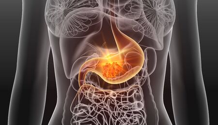 3D illustration showing stomach cancer of a womanの写真素材