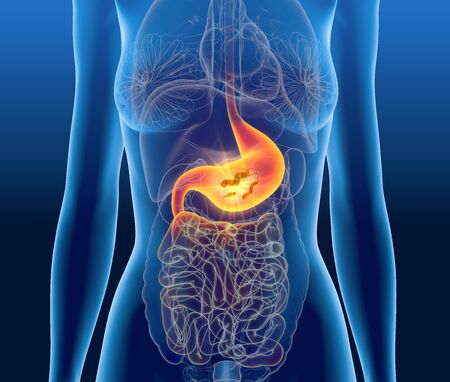 3D Illustration showing Escherichia coli bacteria (E. coli) in painful stomach, medically concept, gastritisの写真素材