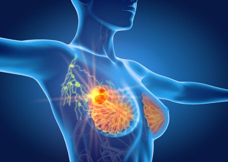 3d illustration showing breast cancer with lymphatics on black backgroundの写真素材