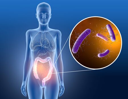 3D illustration showing colitis, clostridium difficile bacteria in large intestineの写真素材