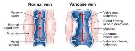 Illustration showing varicose veins and normal veinsの写真素材