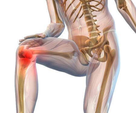 Medicall 3D illustration showing painful osteoarthritic knee joint on white backgroundの写真素材