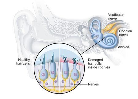 Healthy and damaged hair cells inside cochleaの写真素材