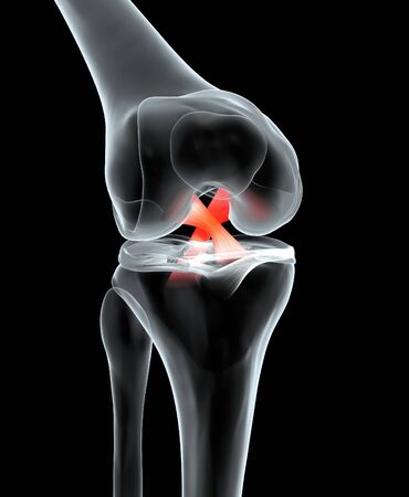 Accurate medically 3D illustration showing painful knee joint with highlighted anterior and posterior cruciate ligament, meniscus, articular cartilage, femur and tibia.の写真素材