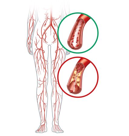 Illustration showing healthy artery and arterioslerotic artery, peripheral artery occlusive disease.の写真素材