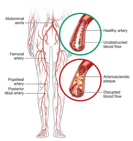 Illustration showing healthy artery and arterioslerotic artery, peripheral artery occlusive disease.の写真素材
