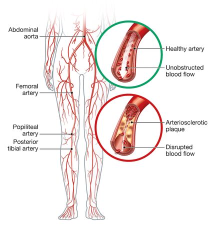 Illustration showing healthy artery and arterioslerotic artery, peripheral artery occlusive disease.の素材 [FY310144216609]