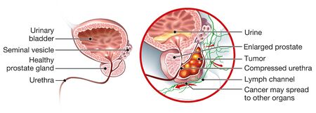 Medically Illustration showing healthy prostate gland and prostate cancer,の写真素材
