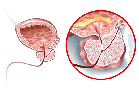 illustration showing healthy prostate and benign prostatic hyperplasia (BPH), enlarged prostate with...