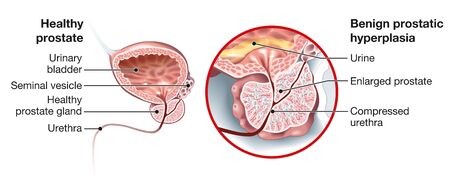 illustration showing healthy prostate and benign prostatic hyperplasia (BPH), enlarged prostate with bladder, urethra and seminal vesicleの写真素材