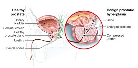 illustration showing healthy prostate and benign prostatic hyperplasia (BPH), enlarged prostate with bladder, urethra and seminal vesicleの写真素材
