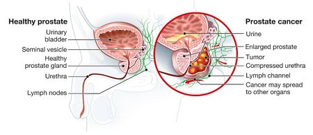 Medically Illustration showing healthy prostate gland and prostate cancer,の写真素材