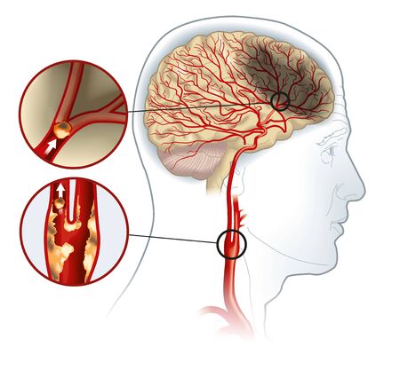 Illustration showing plaque in carotid artery, blood clot breaking off and blocking blood flowの写真素材