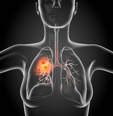 Medical Illustration showing lung cancer or bronchial carcinoma on black background, 3D illustrationの写真素材