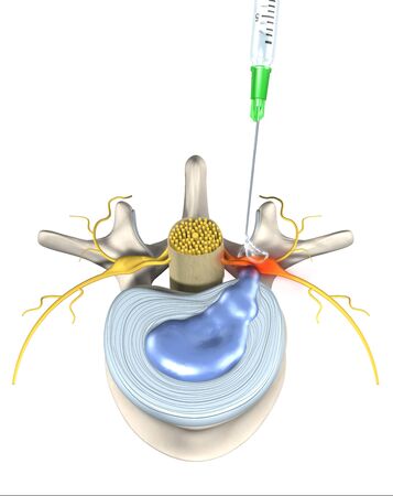 Painful herniated disk, minimally invasive therapy, medically 3D illustration on white background. Injection needle with painkillerの写真素材