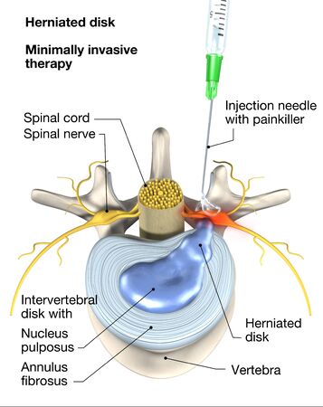 Painful herniated disk, minimally invasive therapy, medically 3D illustration on white background. Injection needle with painkillerの写真素材