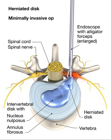 Painful herniated disk, minimally invasive therapy, medically 3D ilustration on white background.の写真素材