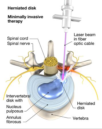 Painful herniated disk, minimally invasive therapy with laser beam in optic cable. Medically 3D illustration on white background. Injection needle with painkillerの写真素材