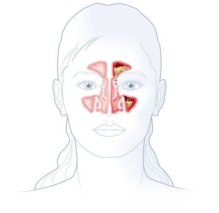 Illustration showing healthy sinus and sinusitis with inflamed lining, obstructed sinus opening, adenoid and excess mucusの写真素材