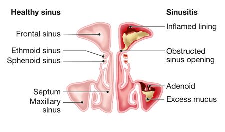 Illustration showing healthy sinus and sinusitis with inflamed lining, obstructed sinus opening, adenoid and excess mucusの写真素材