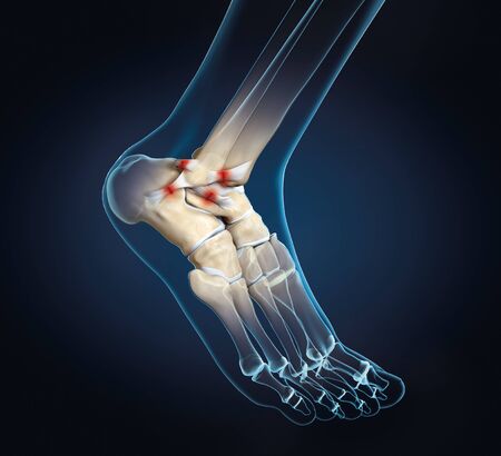 3D illustration showing rupture of a ligament in ankle jointの写真素材
