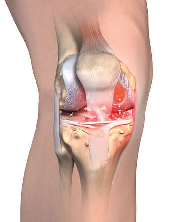 Illustration showing painful rheumatoid arthritis knee jointの写真素材