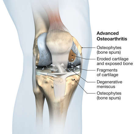 Illustration showing painful advanced osteoarthritic knee jointの写真素材