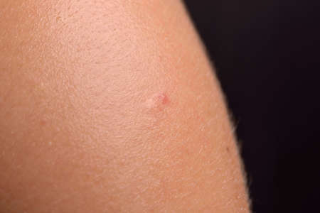 Close up of red pimple, still unformed on young man skin on black backgroundの写真素材