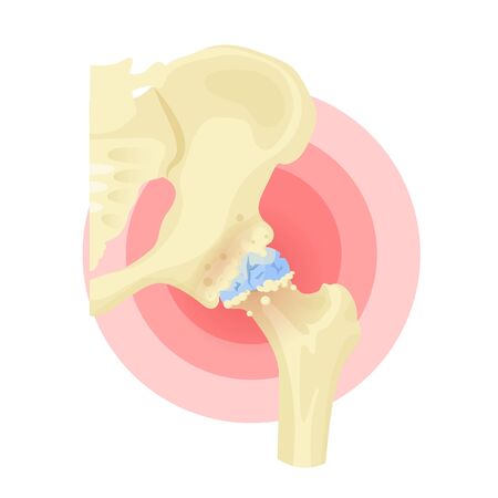 Rheumatoid arthritis diagnosis, medical therapy of body ache. Vector flat style cartoon illustration isolated on white backgroundのイラスト素材