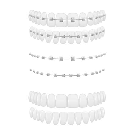 Braces on white teeth and after cure orthodontic dentistry medical treatment set realistic vectorのイラスト素材